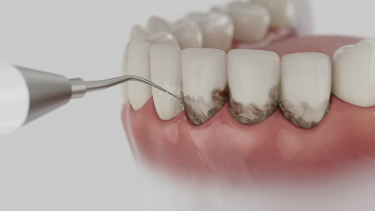 Trusted Dental Crowns And Bridges service in Venice Gardens, FL - Dentist Open Now